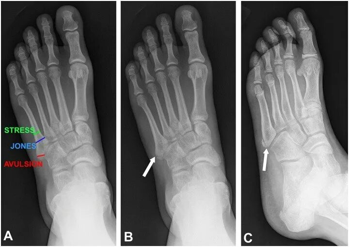 Пятая плюсневая кость фото Fractures of the fifth metatarsal base. Frontal radiograph (A)... Download Scien