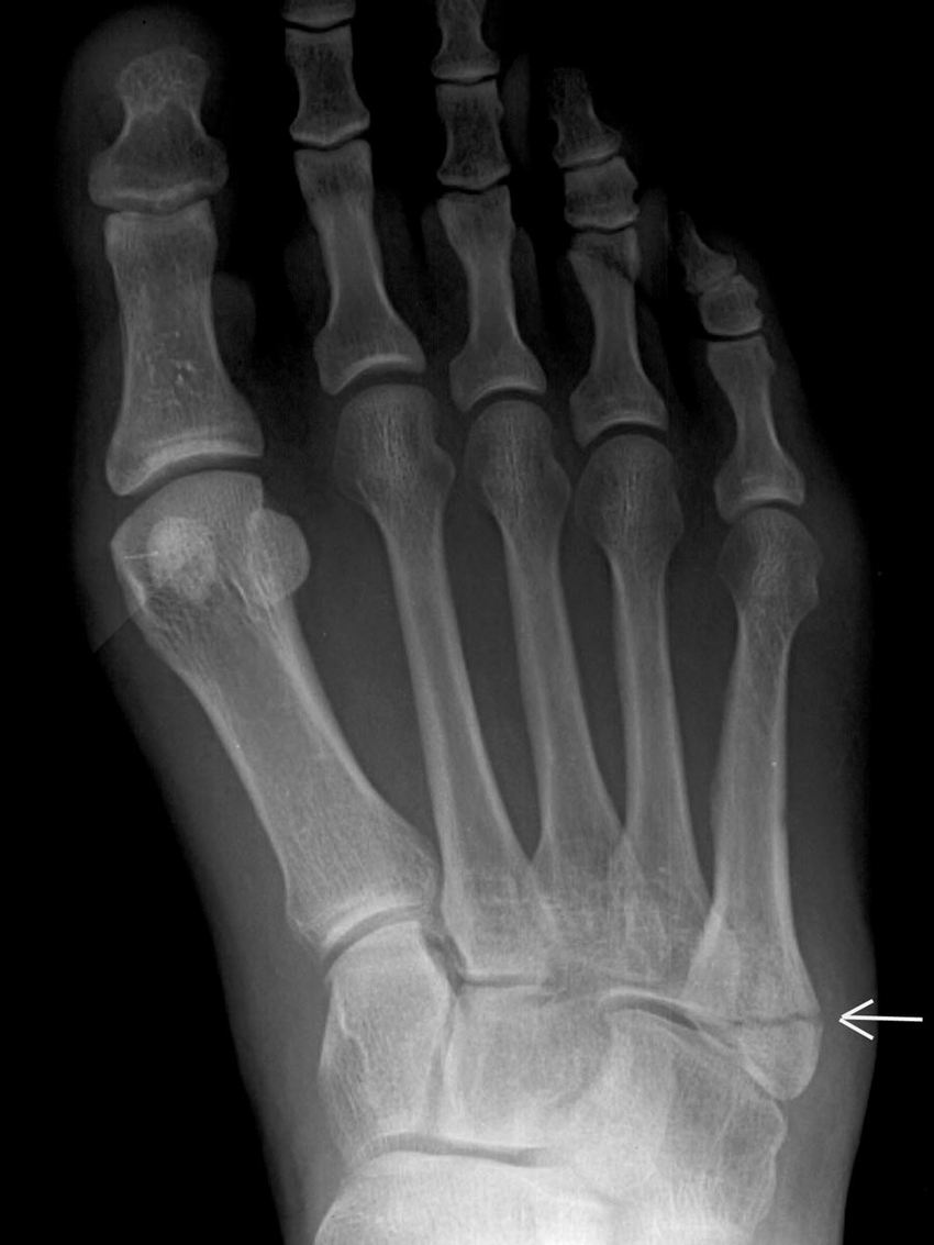 Пятая плюсневая кость фото Dancer fracture. Frontal radiograph of the foot shows an oblique,... Download Sc