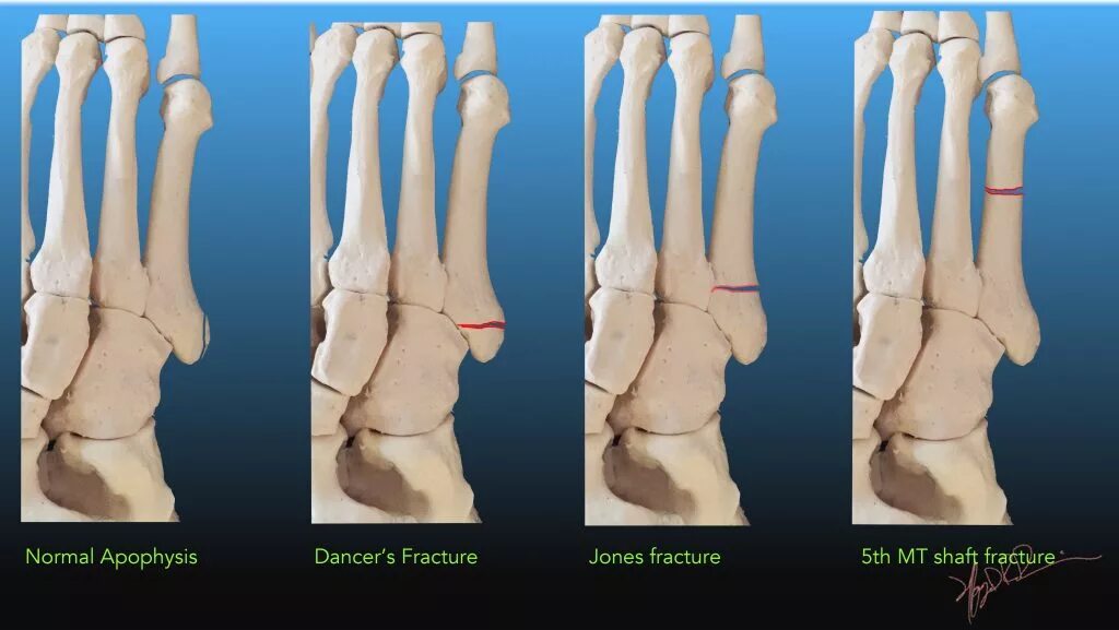 Пятая плюсневая кость фото Fractures of the Fifth Metatarsal Base UW Emergency Radiology