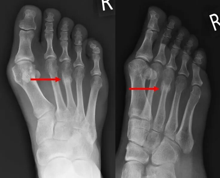 Пятая плюсневая кость где находится фото перелом Pin on Kinetic Orthotic Tips