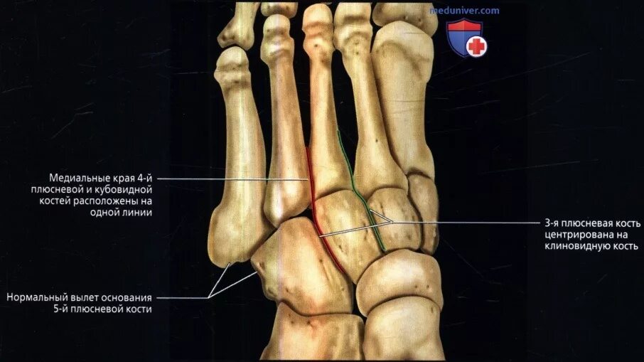 Пятая плюсневая кость стопы где находится фото Размеры и линии стопы, голеностопного сустава