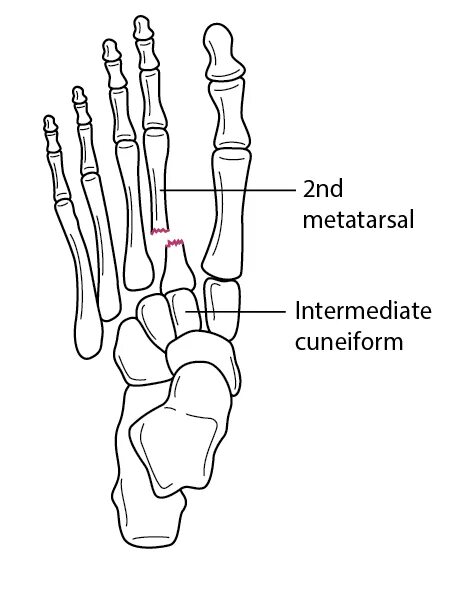 Пятая плюсневая кость стопы где находится фото Table: Fracture of the 2nd metatarsal base with tarsometatarsal joint dislocatio