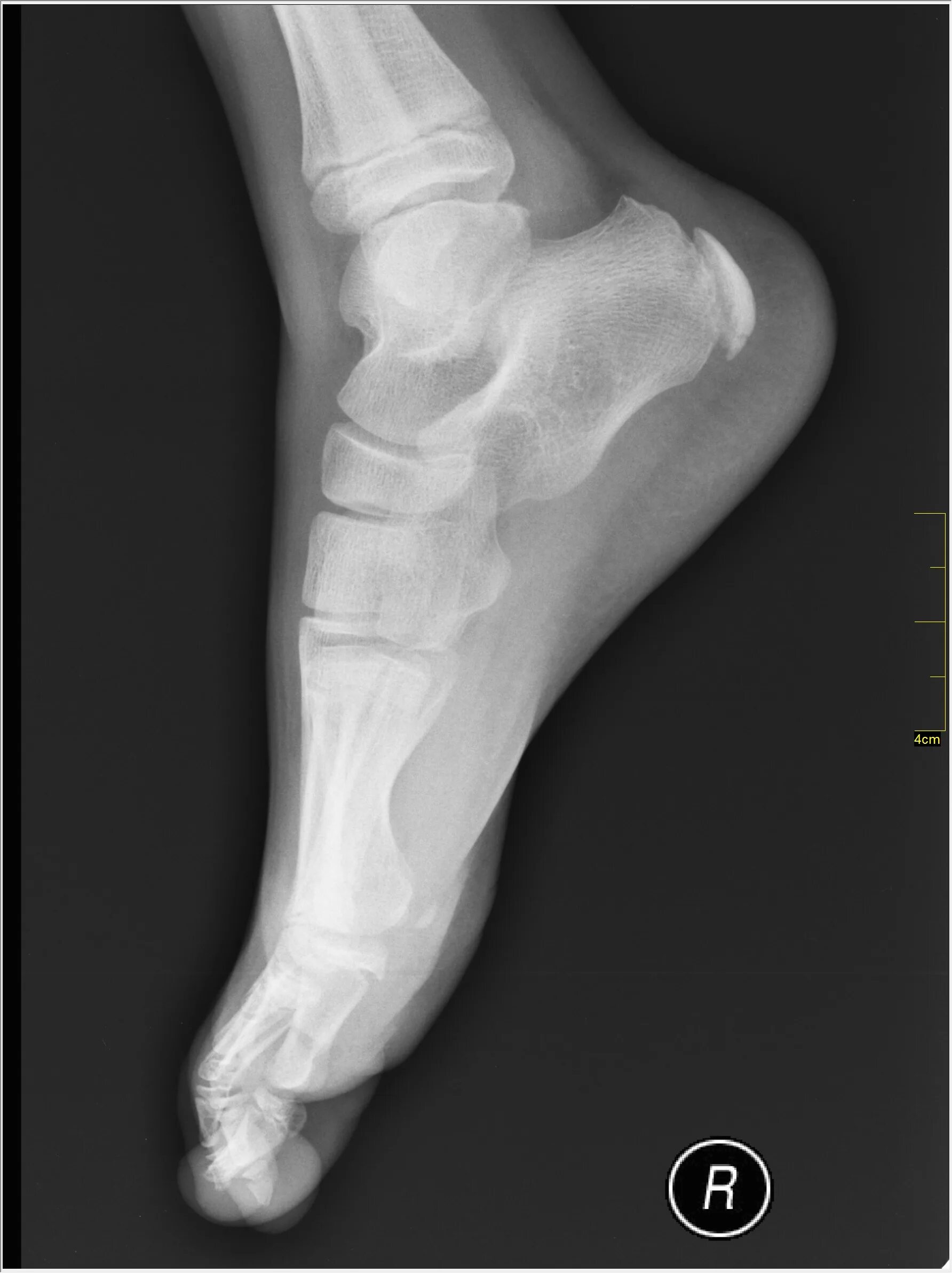 Пятка кость фото File:Medical X-Ray imaging TKL07 nevit.jpg - Wikimedia Commons