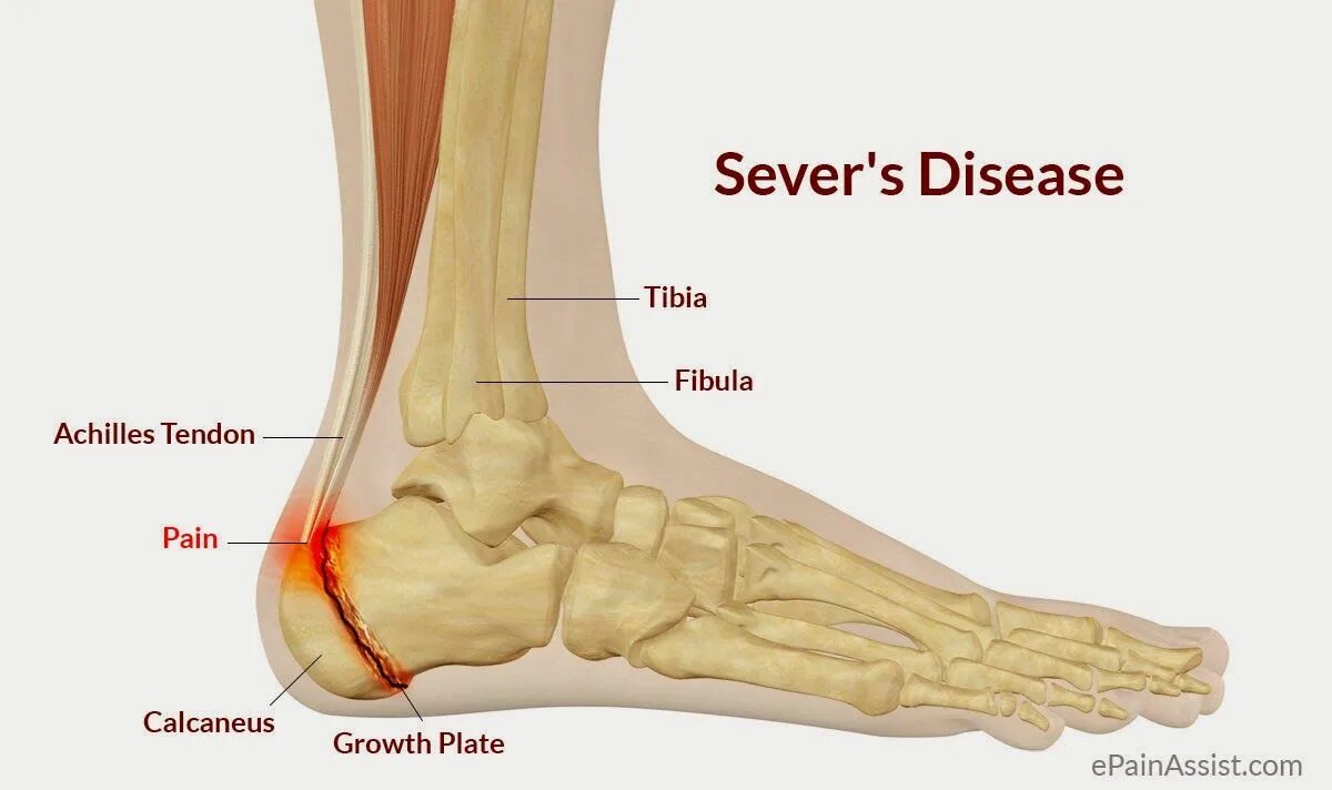 Пятка кость фото Afbeeldingsresultaat voor apofyse calcaneus Heel pain, Disease, Severe