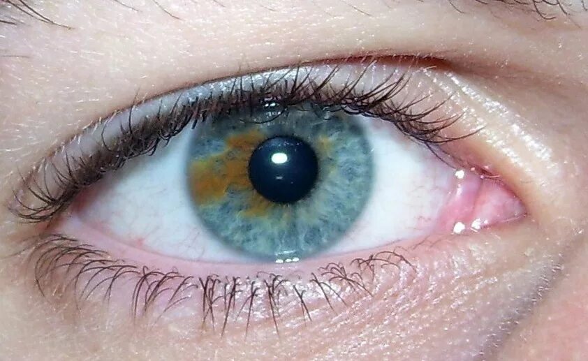 Пятна на глазах на фото Файл:Sectoral heterochromia.jpg - Википедия