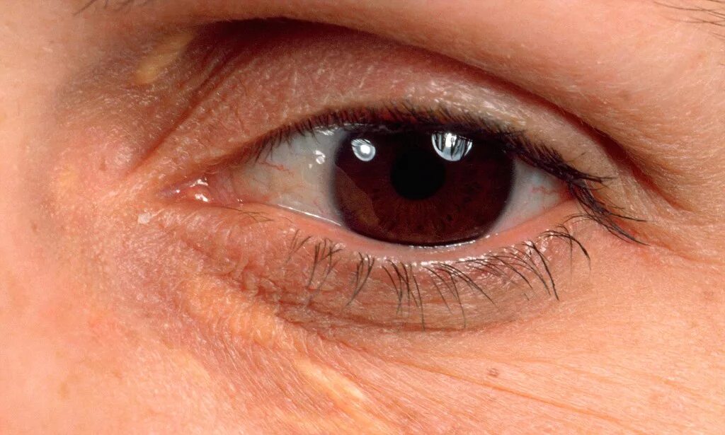 Пятна на глазах на фото Yellow eyelid marks (xanthelasma) 'early warning sign of heart disease'