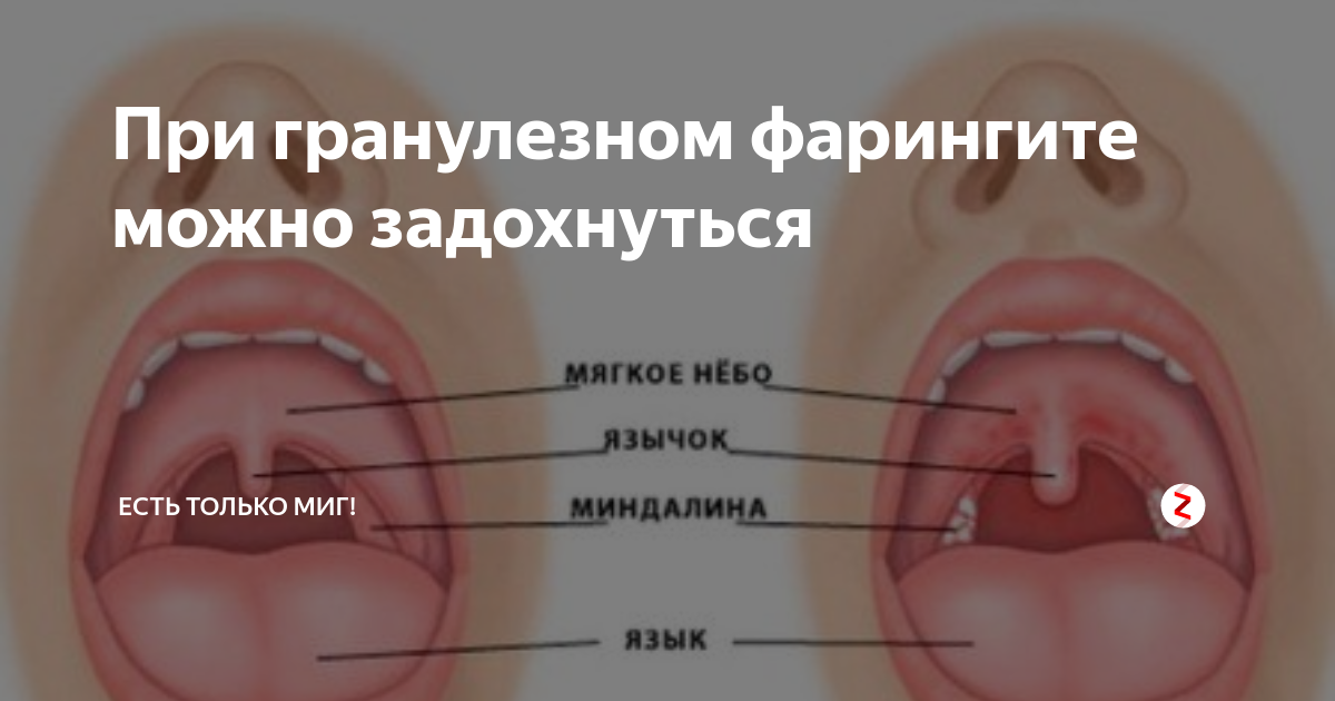 Мягкое нёбо: функции, строение, болезни, лечение