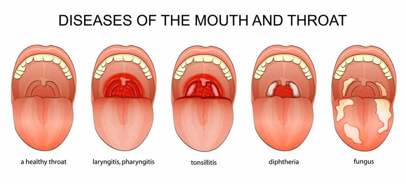 Пятна на горле у ребенка фото Strep Throat Зображення - огляд 1,501 Стокові фото, векторні зображення й відео 