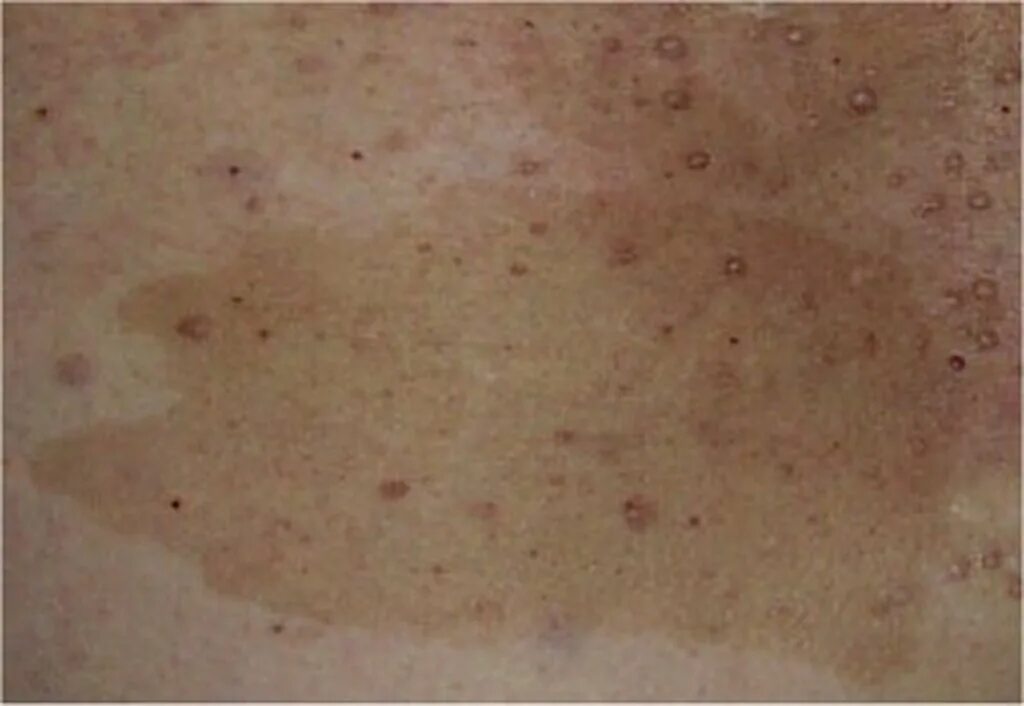 Пятна на коже при болезни печени фото CAFÉ AU LAIT LESIONS - Dermatology Conditions and Treatments