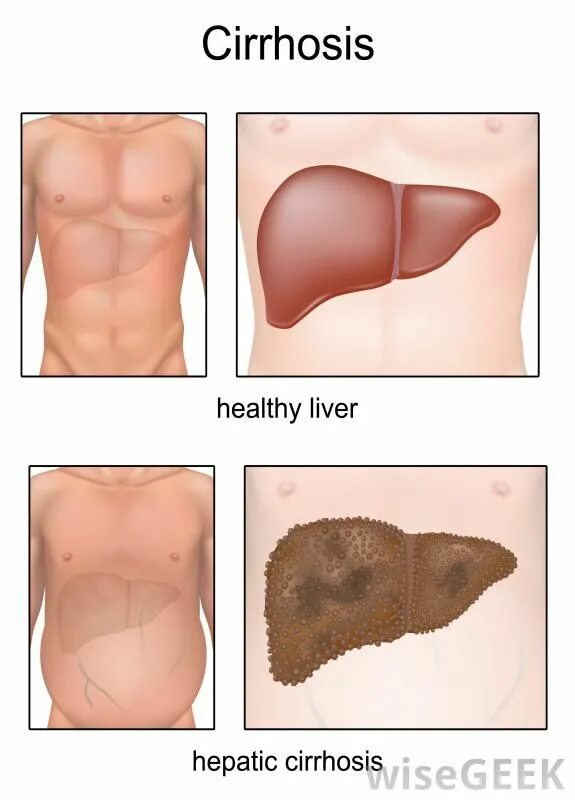 Пятна на коже при заболевании печени фото Pin on Med-Surg: Exam 3