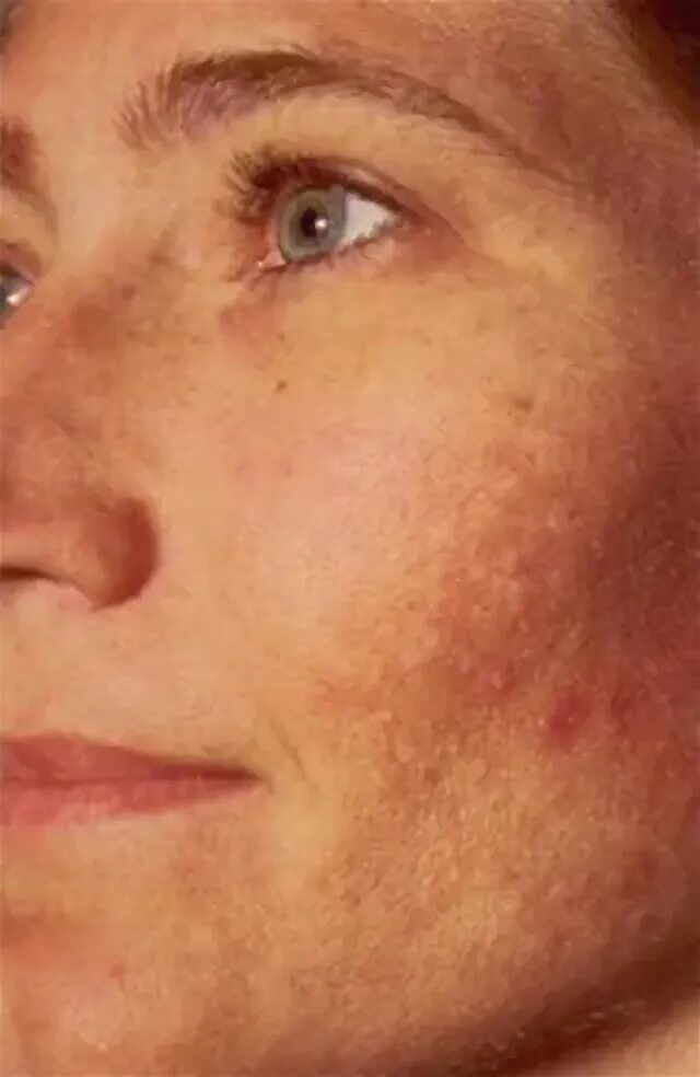 Пятна на лице от печени фото Melasma: más allá de una simple mancha MSC Noticias