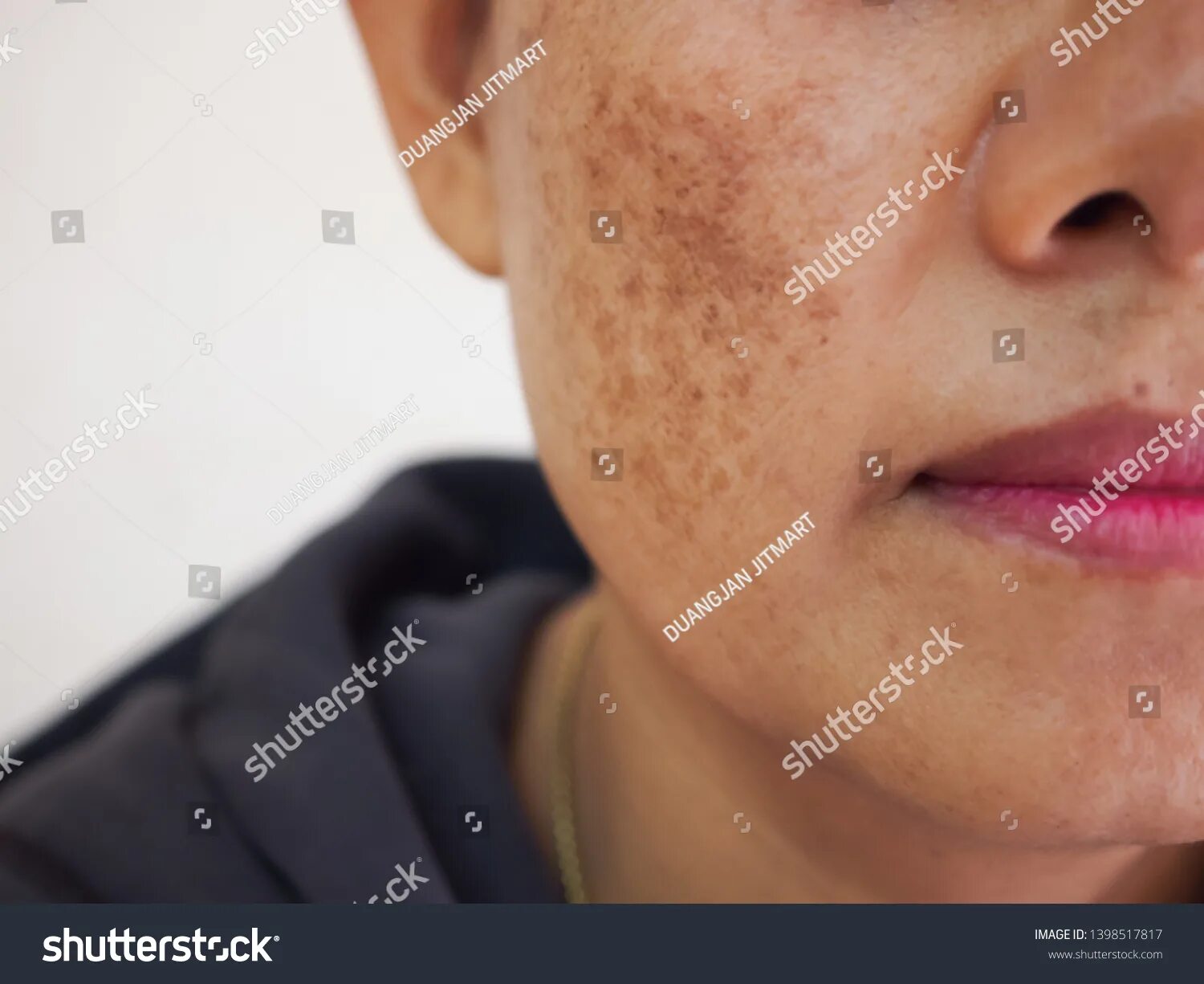 Пятна на лице от печени фото 6.599 Dark spot on face Gambar, Foto Stok & Vektor Shutterstock