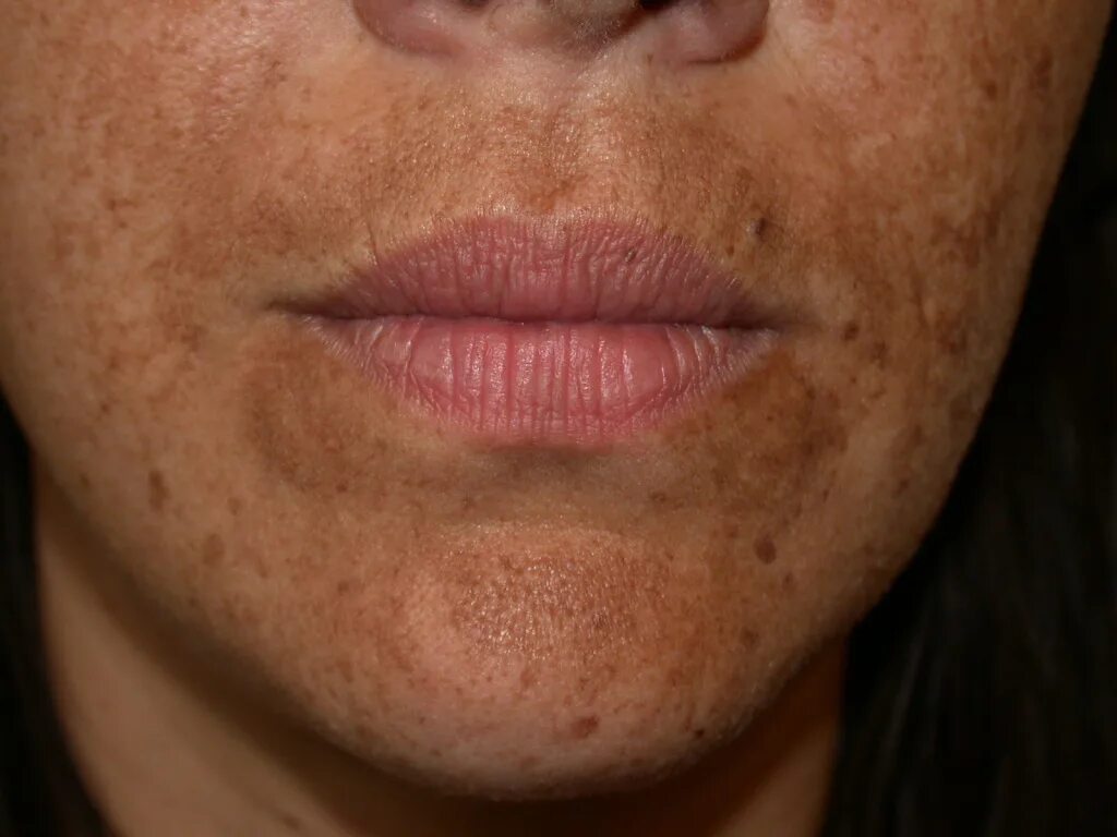 My face is always flushed. Is this rosacea or something else?