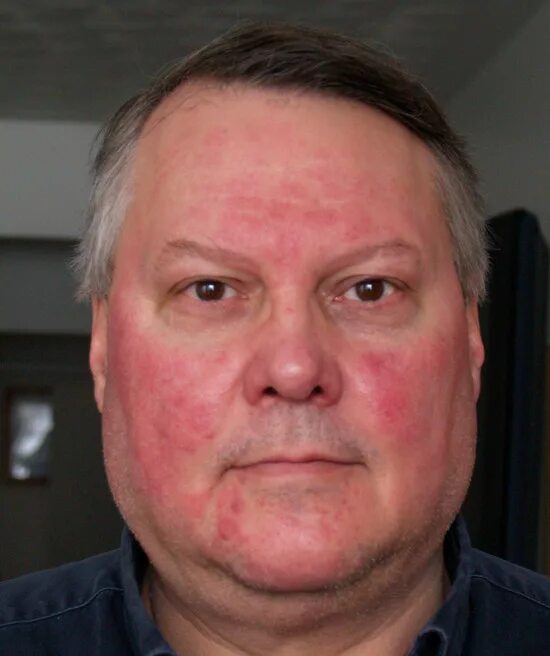 Пятна на лице после алкоголя фото My face is always flushed. Is this rosacea or something else?