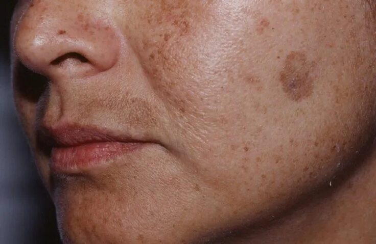 Пятна на лице при болезни печени фото Slavens dermatologs parādīja, kā atbrīvoties no brūnajiem pleķiem uz sejas ādu a