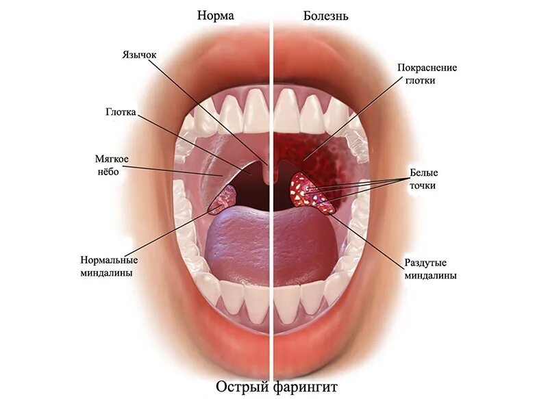 Пятна на небе во рту фото Кариес и ангина: что их связывает?