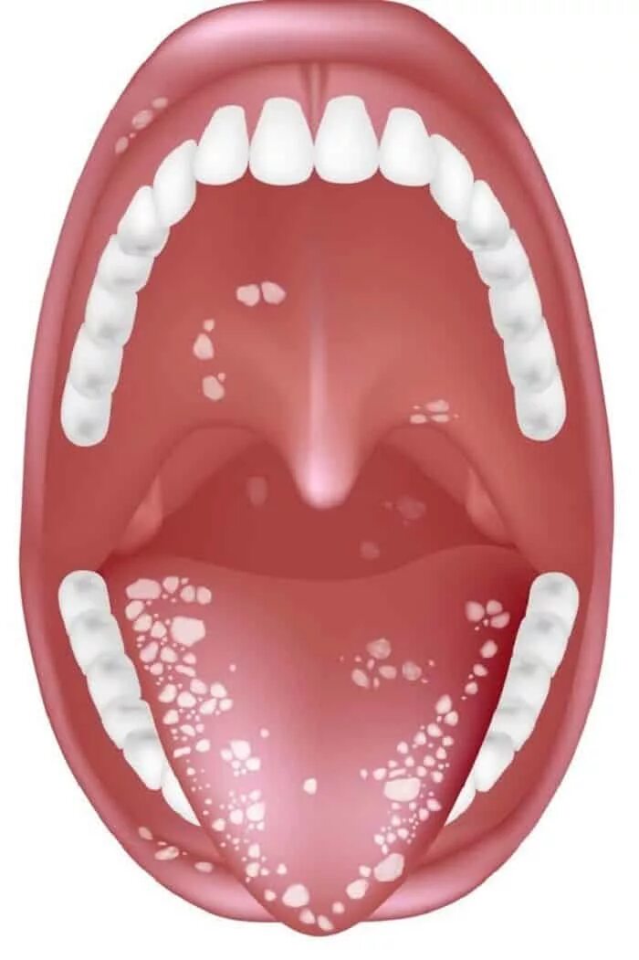 Пятна на небе во рту фото Лечение стоматита у детей: симптомы, классификация, профилактика Цены на стомато