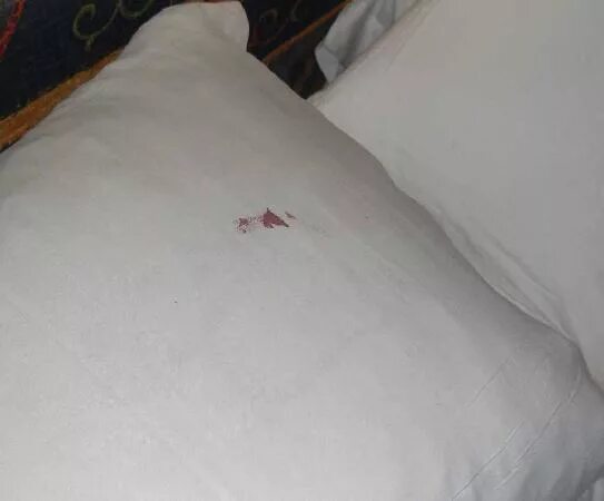 Пятна на постели от клопов фото Blood stained pillow - Picture of Hotel BelleVue Aquarius, Lanzarote - Tripadvis