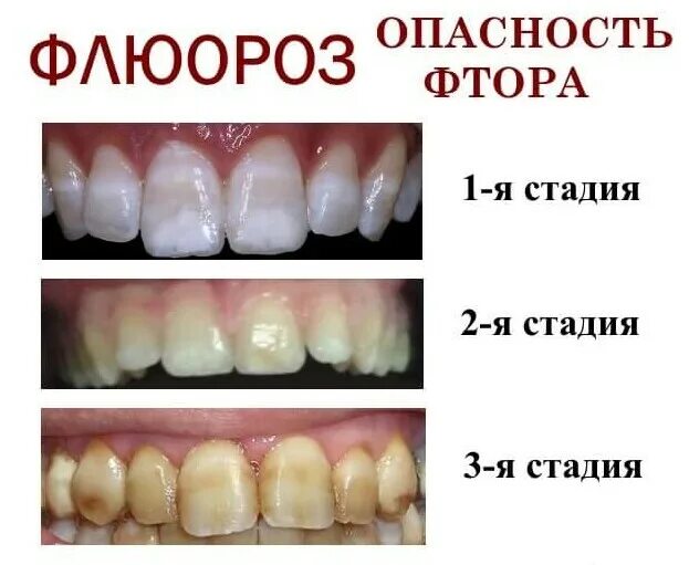 Пятна на зубах фото Профилактика и лечение флюороза "Стоматолог и Я"