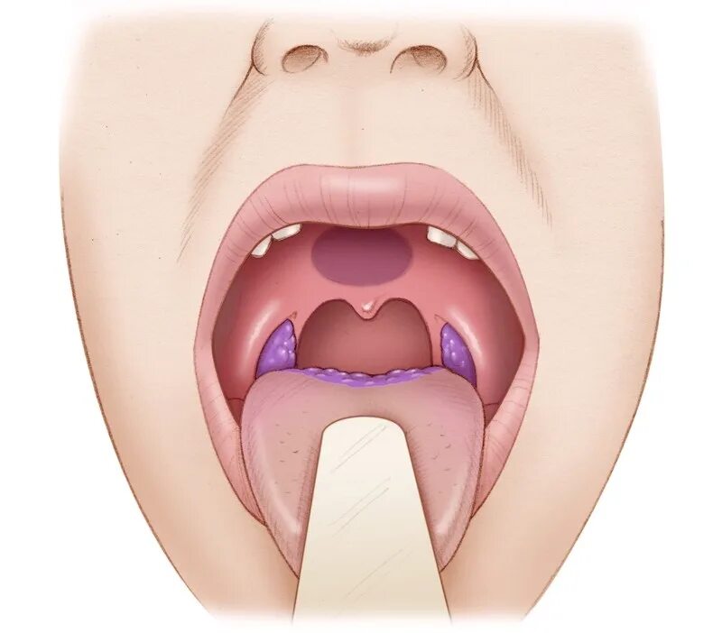 Пятно в горле фото Oropharyngeal Cancer Otolaryngology - Head & Neck Surgery Stanford Medicine