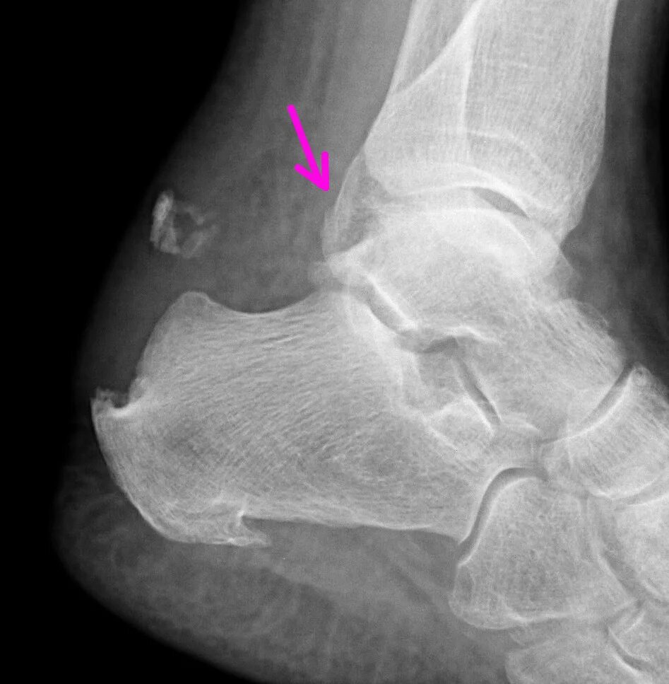 Пяточная кость фото Пяточная кость. Портал радиологов