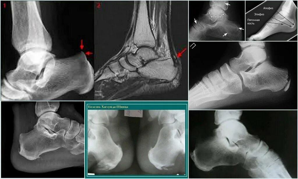 Пяточная кость фото Болезнь пяточной кости у детей