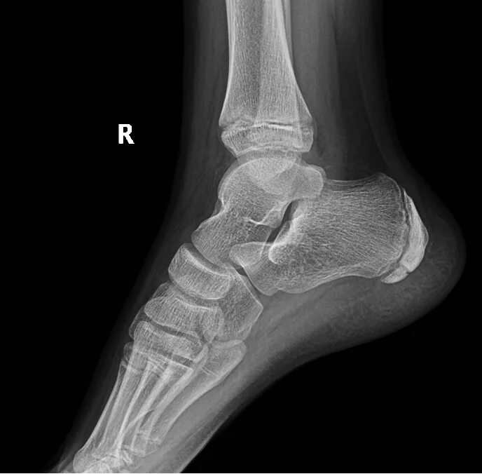 Пяточная кость фото Клинические случаи рентгенологического отделения - НЦЗД