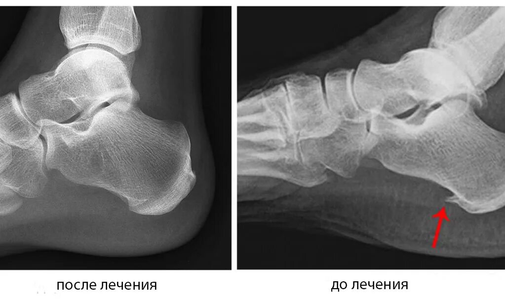 Пяточная кость фото Вальгус