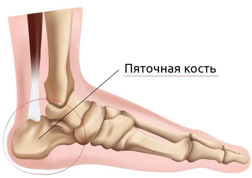 Пяточная кость фото Остеохондропатия пяточной кости: симптомы и лечение