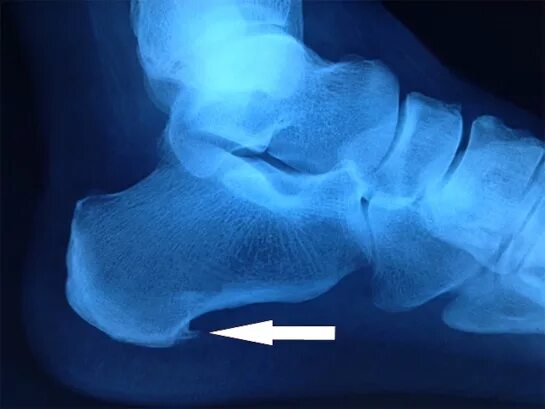 Пяточная кость фото Лечение пяточной шпоры в Усть-Каменогорске - Медицинский Центр Пульс