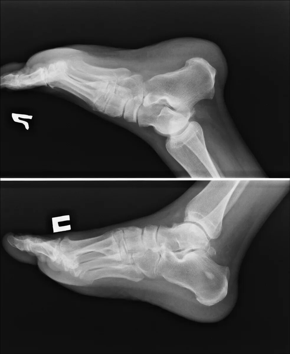 Пяточная кость фото как выглядит у человека Портал радиологов