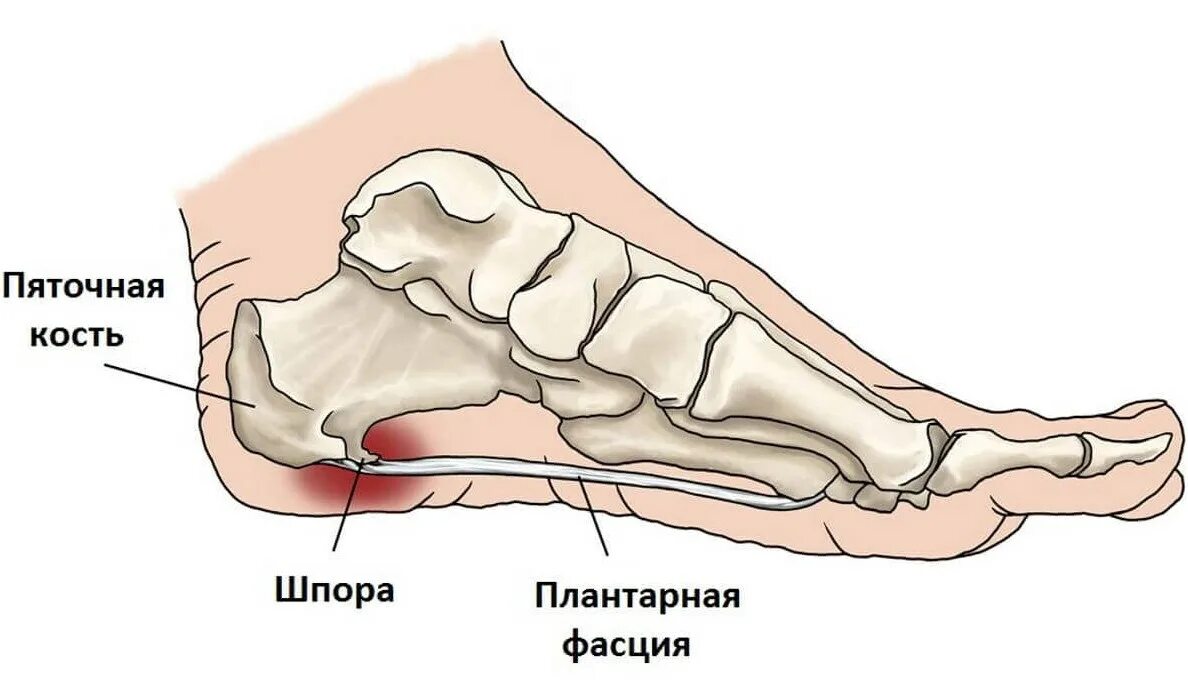 Пяточная шпора фото как выглядит Диагностический центр № 3 г. Москвы