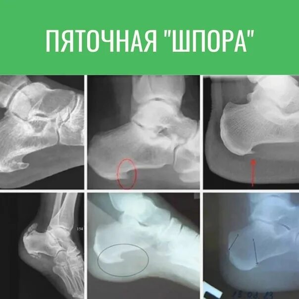 Пяточная шпора фото как выглядит Treatment of heel spurs. Do you feel pain when walking? Discomfort? Maybe you ha