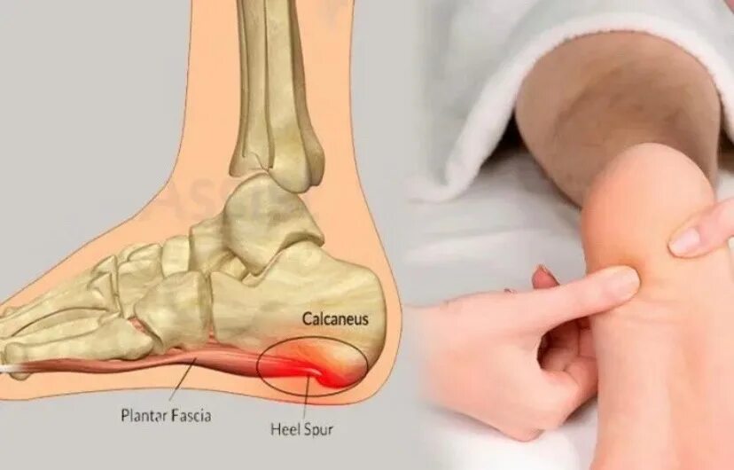 Пяточная шпора фото как выглядит ПЯТОЧНАЯ ШПОРА Пяточная шпора начинается с укорочения фасции. И воспаления связо