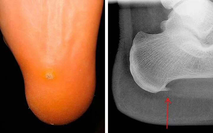 Пяточная шпора фото как выглядит Пяточная шпора симптомы и лечение в домашних условиях