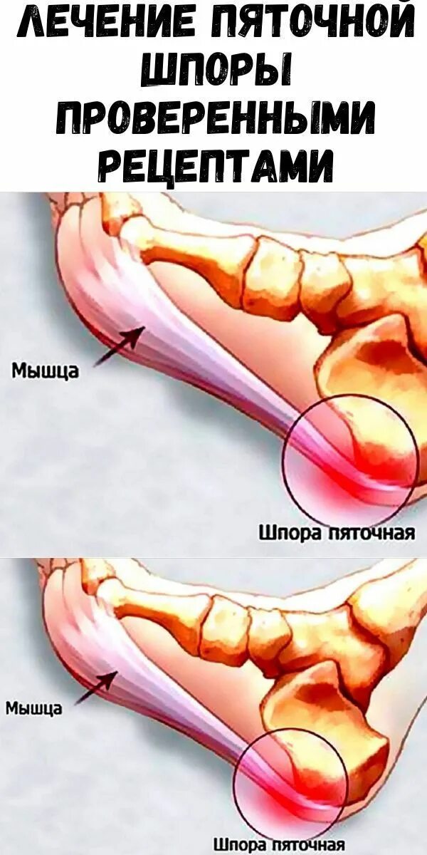 Пяточная шпора фото как выглядит на пятке Журнал для женщин Лечение, Лечение герпеса, Здоровье ног