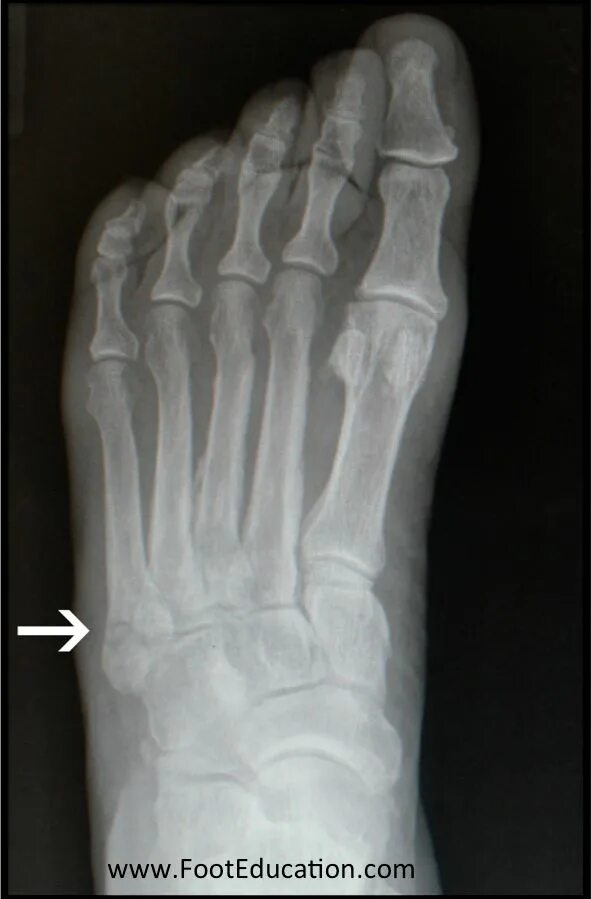 Пятой плюсневой кости стопы фото Jones Fracture - FootEducation Avulsion fracture, Jones fracture, Metatarsal fra