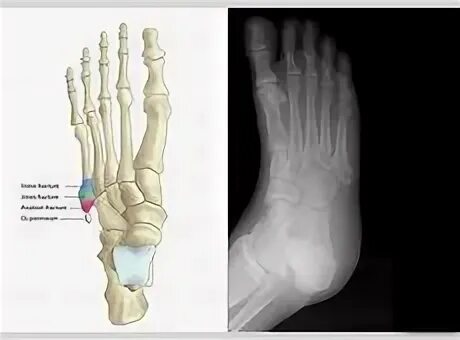 Пятой плюсневой кости стопы фото Пятой Плюсневой Кости Стопы Фото - Telegraph