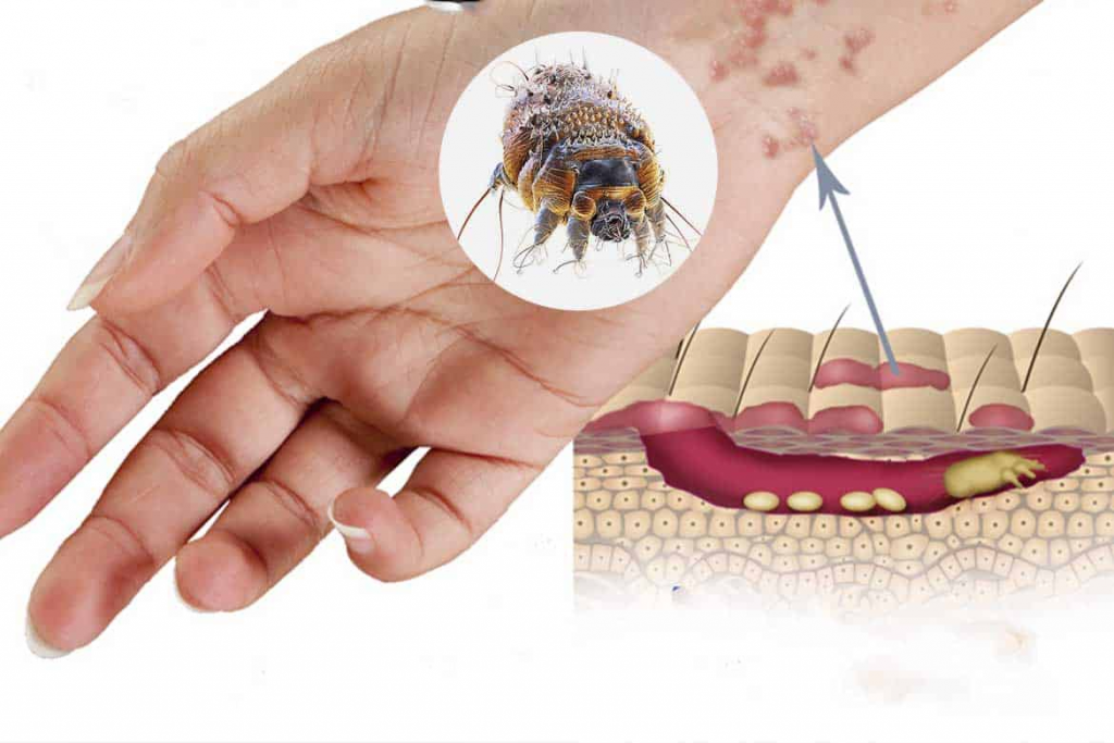 Пылевой клещ на коже человека фото О мерах профилактики чесотки