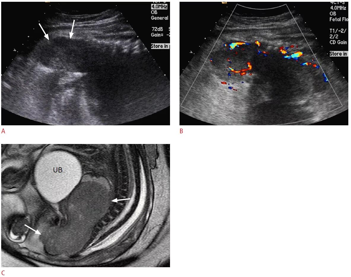 Рабдомиосаркома мягких тканей на узи фото Пухлини плоду: пренатальні УЗД і клінічні характеристики