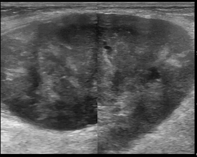 Рабдомиосаркома мягких тканей на узи фото Image Radiopaedia.org