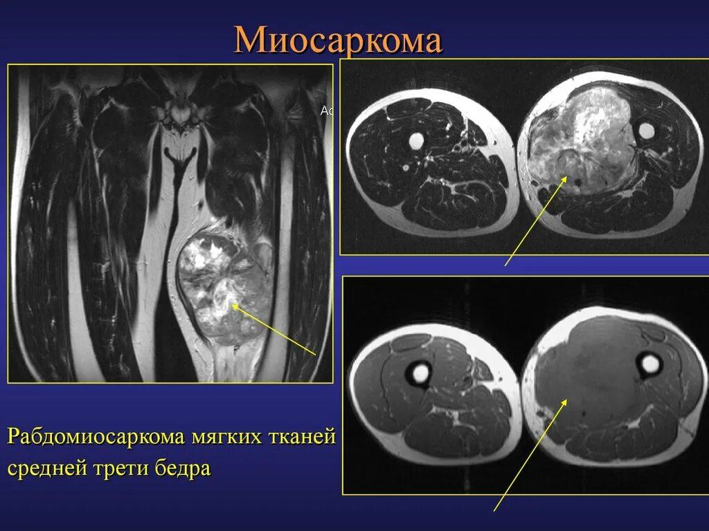 Рабдомиосаркома мягких тканей на узи фото Доброкачественная мышечная опухоль