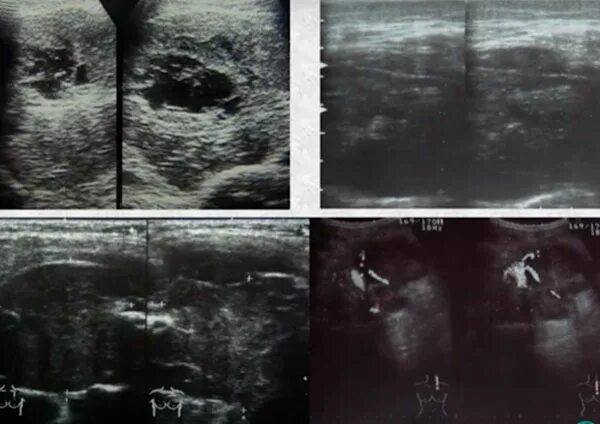 Рабдомиосаркома мягких тканей на узи фото Саркома мягких тканей: УЗИ, признаки, симптомы provrach.ru