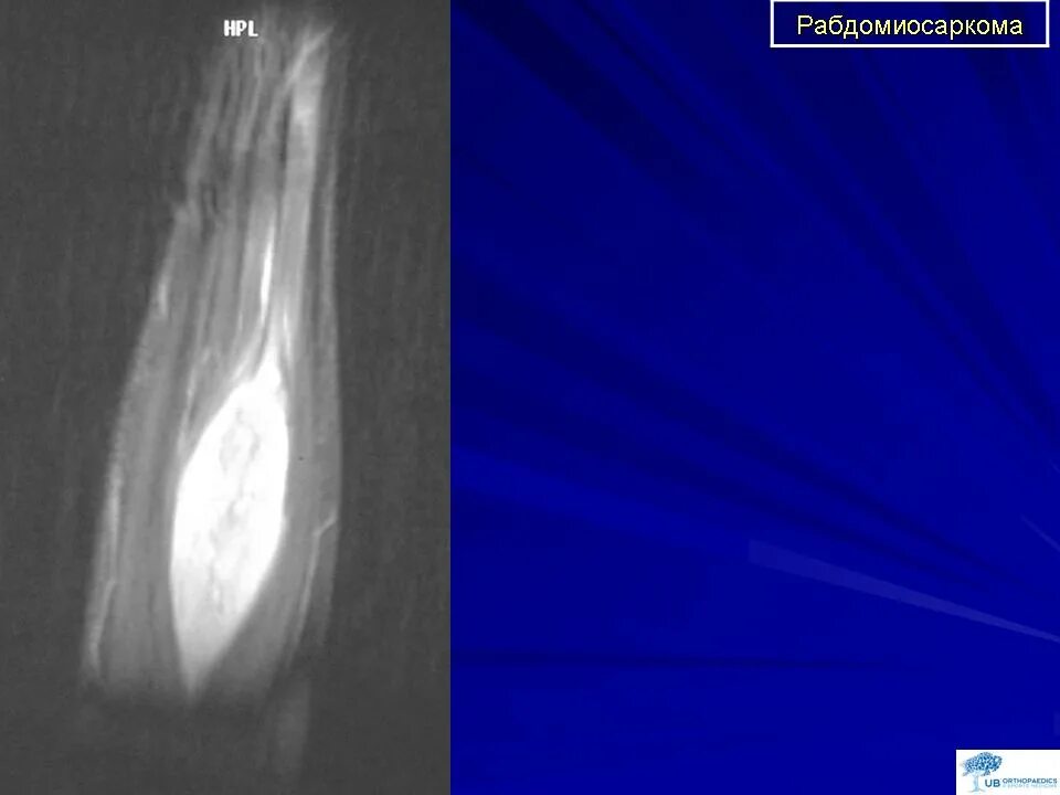 Рабдомиосаркома мягких тканей на узи фото Онкология. Саркома. Рабдомиосаркома. + Портал радиологов