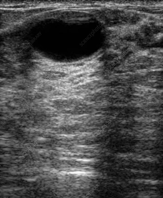 Рабдомиосаркома мягких тканей на узи фото Fibrocystic disease, ultrasound scan - Stock Image - M122/0437 - Science Photo L