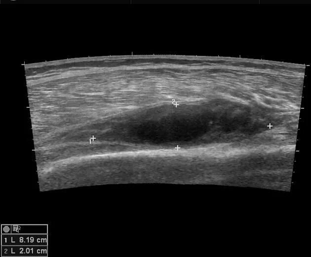 Рабдомиосаркома мягких тканей на узи фото Abscess in thigh Radiology Case Radiopaedia.org Radiology, Diagnostic medical so