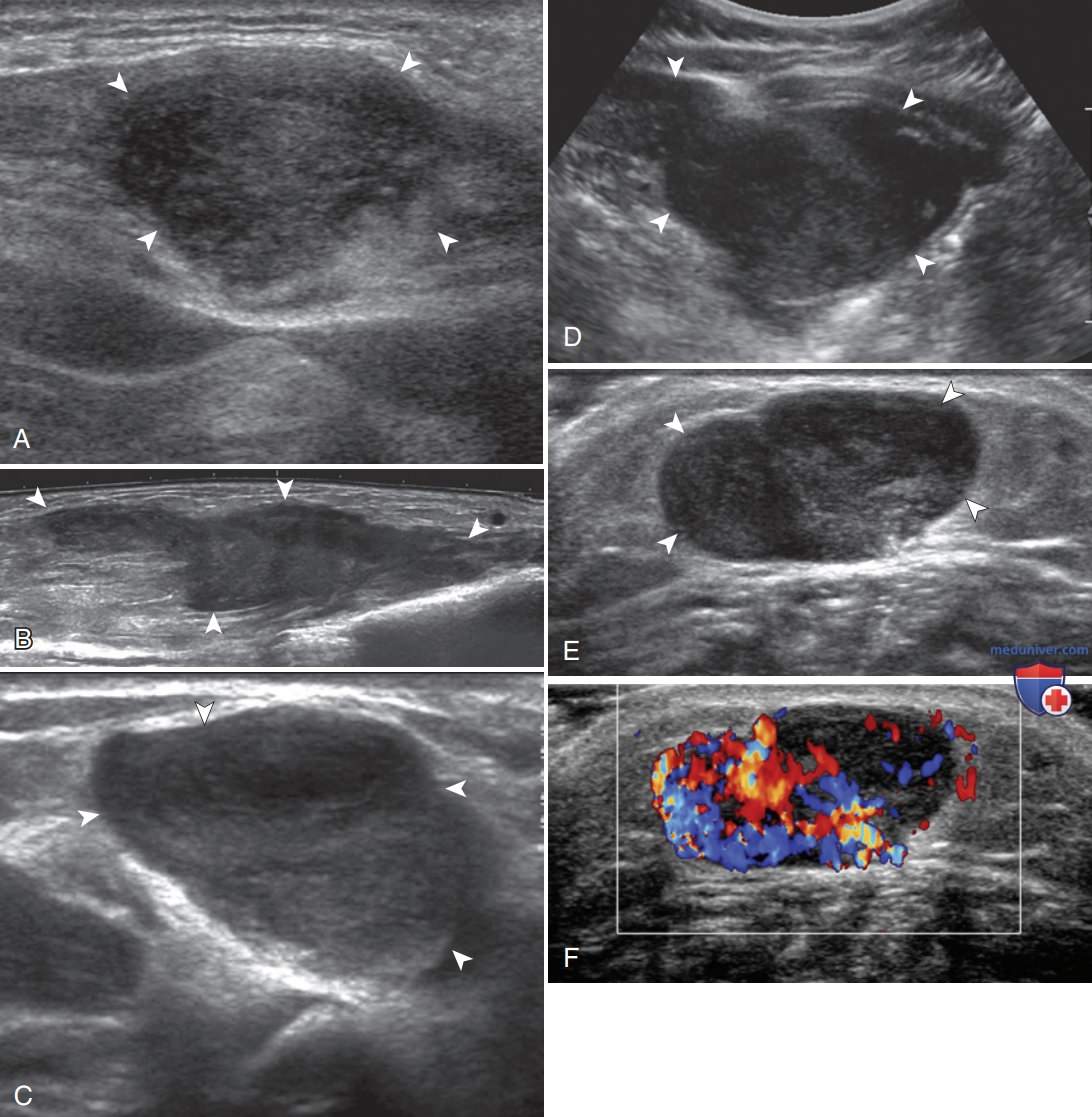 Рабдомиосаркома мягких тканей на узи фото УЗИ признаки злокачественной опухоли мягких тканей