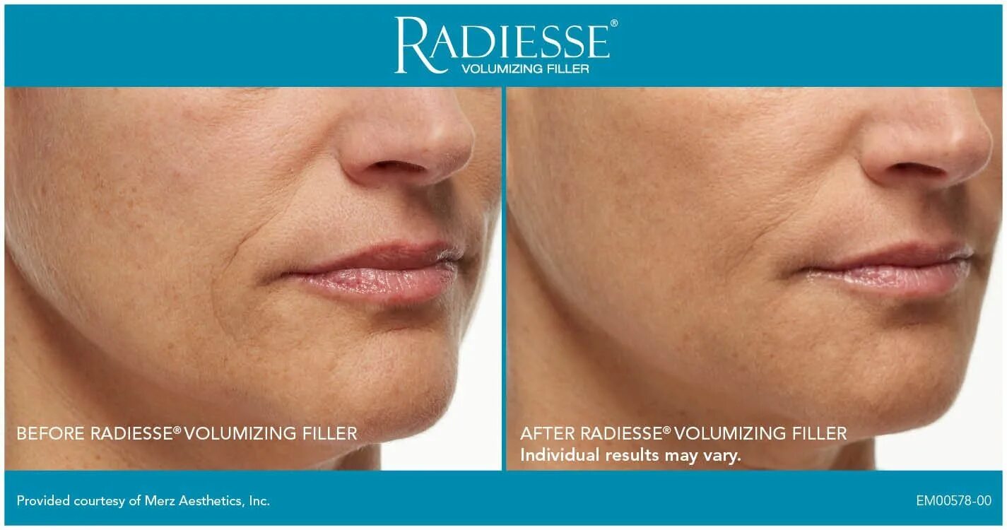 Радиесс фото до и после #RADIESSE FILLER- Great for deep folds or for volumizing cheeks. Dermal fillers,