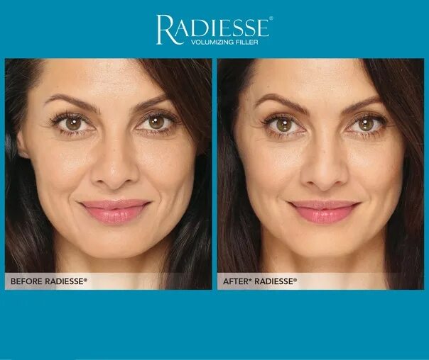 Радиесс отзывы фото до и после How Radiesse helps get rid of flabby skin ❓ This drug has a special structure an