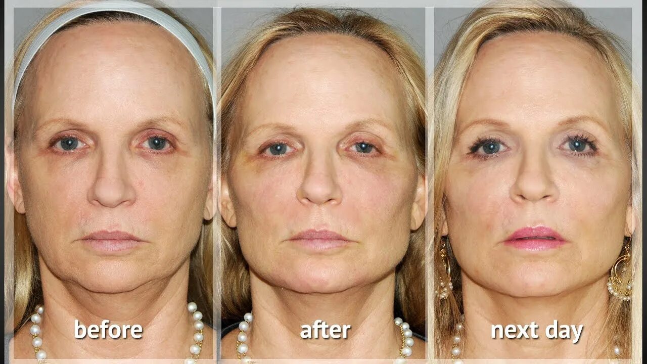 Радиесс отзывы фото до и после цена Y LIFT ® 2012 - Catherine Instant, Non Surgical Facelift - YouTube